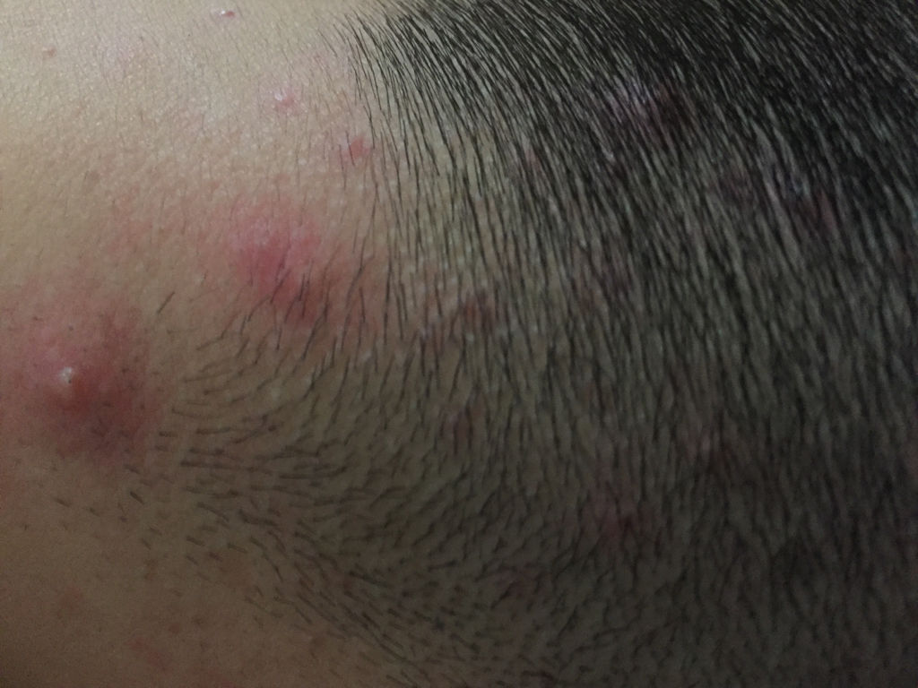 后脑勺长了许多痘痘