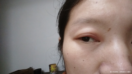 眼睛疼又肿是怎么回事