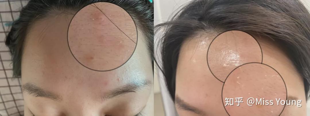 刷酸可以让痘痘快速成熟吗
