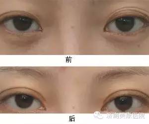 为什么双眼皮会变成三眼皮