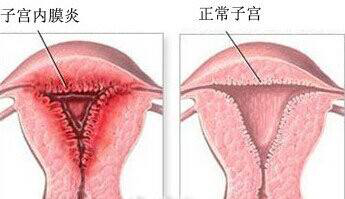 内膜增厚怎么治疗好