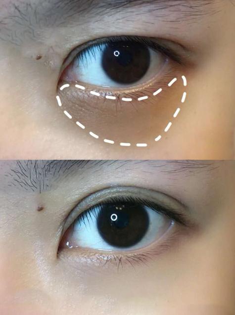 眼霜去黑眼圈有用吗