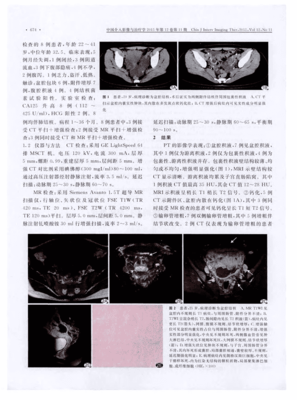 治疗盆腔结核费用多少