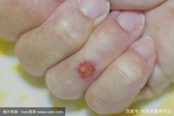 孕妇汗疱疹怎么治疗