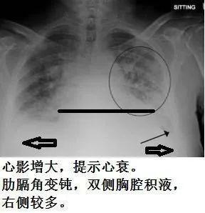心脏影增大是怎么回事