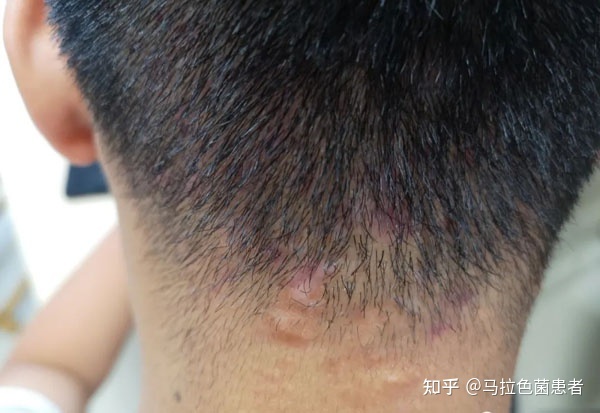 怎样消除疤痕疙瘩
