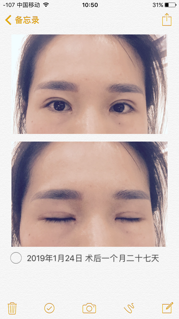 割完双眼皮恢复期
