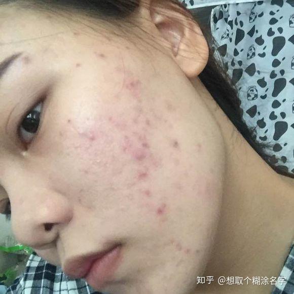 资深痘痘
