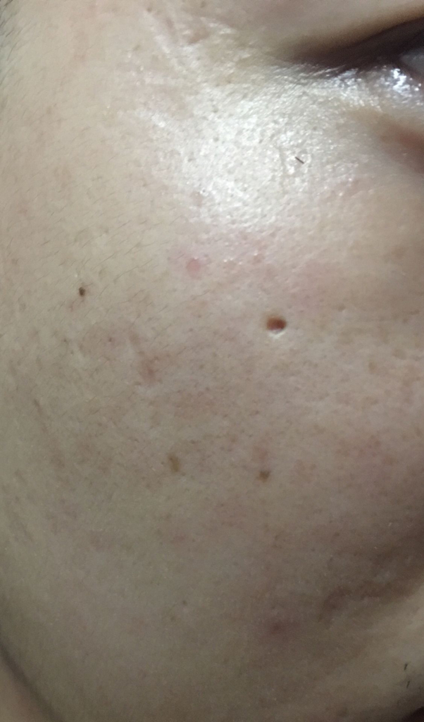 施尔美痘痘怎么消除