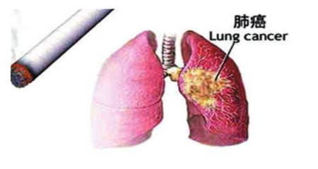 肺癌