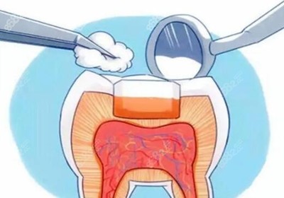 3m补牙材料价格