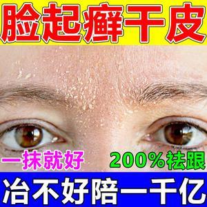 脸部过敏干皮怎么办