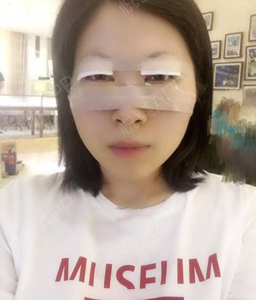 江门市双眼皮华美出众