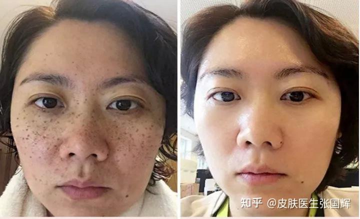 激光祛斑一般需要多少钱