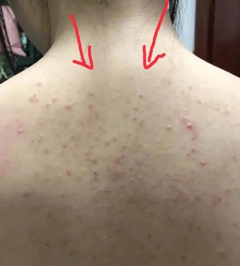 夏天背上起了很多痘痘