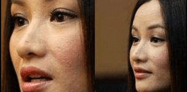 瞿颖痘痘如何治好的