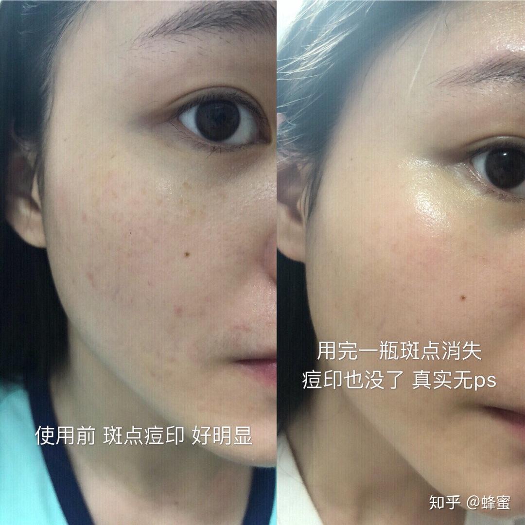 痘印变黑了还能好吗