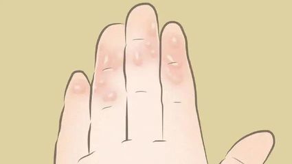 孕妇汗疱疹怎么治疗