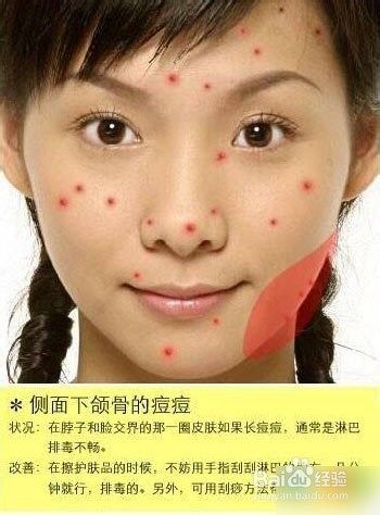 右边侧面长痘痘